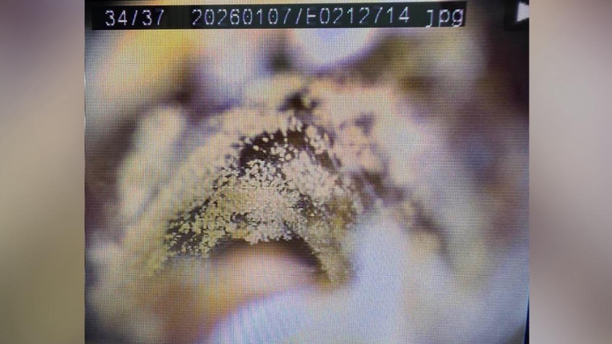 愛挖耳注意！她耳悶癢內視鏡驚見「毛茸茸一片」　醫看傻：長菇了