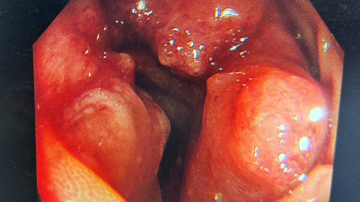 血便以為痔瘡!台中男44歲就大腸癌 中鏢機率高3倍原因曝