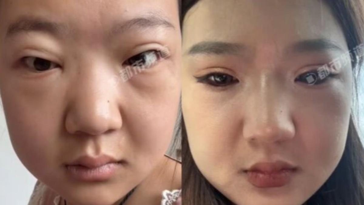 以為吃胖!24歲女暴肥33kg「發燒臉腫」竟罹尿毒症:只是愛吃辣