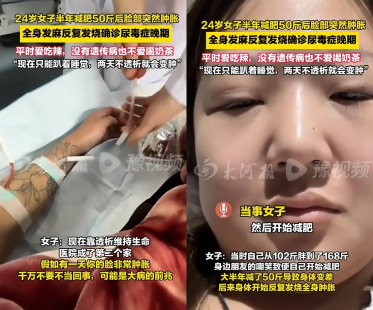 小然腎臟功能喪失,需至醫院洗腎排毒。(圖/翻攝中國報)