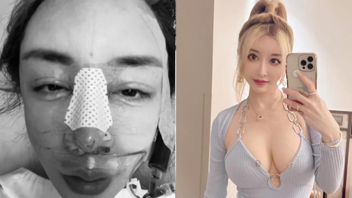 雪碧才整形失敗!上海動刀掰了「12年超假鼻子」 驚悚「插管」模樣曝