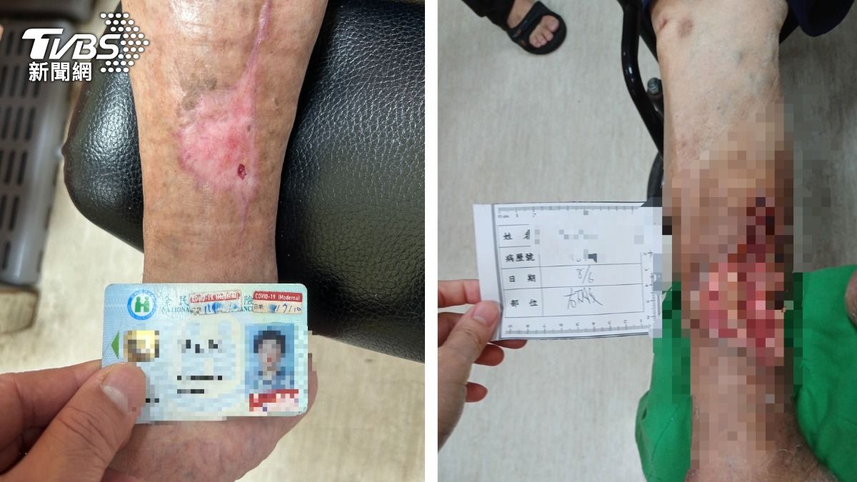 傷口快比健保卡大！七旬婦小腿「爛到見骨」　元凶藏在血管