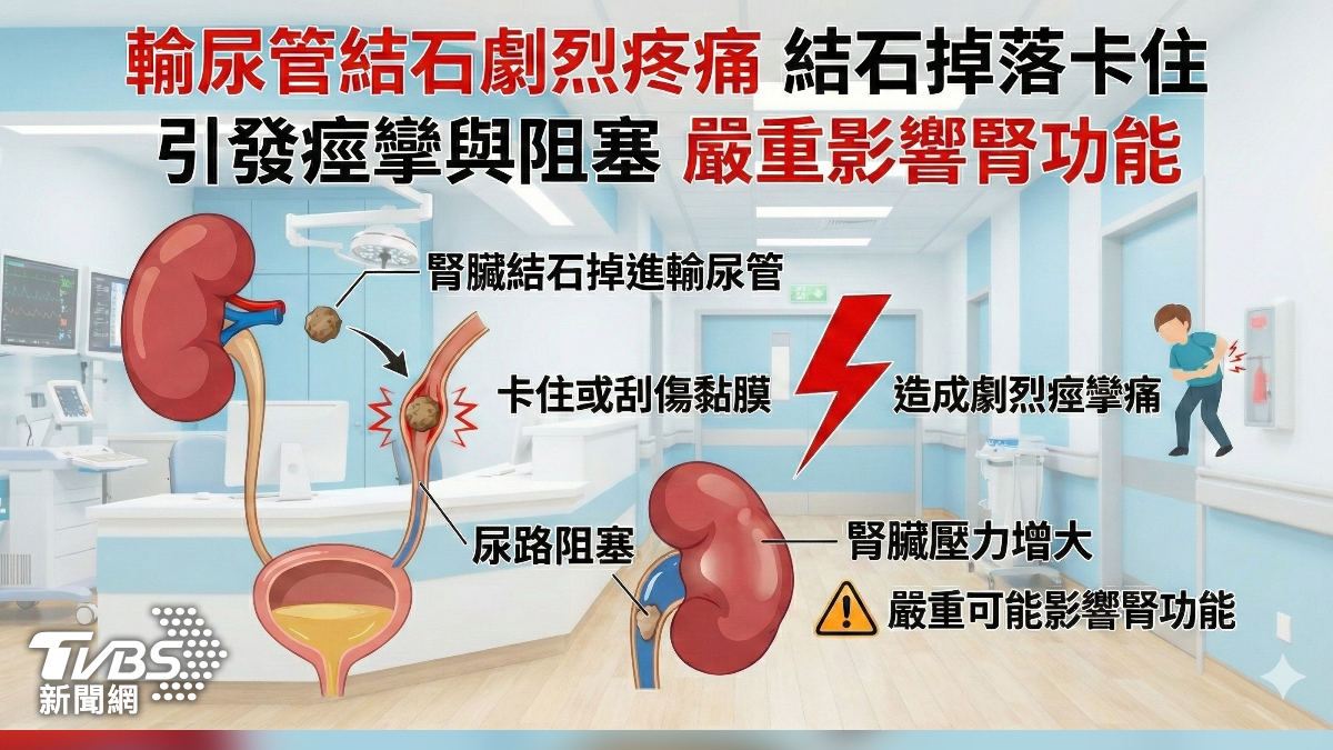 尿道結石恐敗血症 醫師示警:尿不出速就醫! (圖/蔣志偉)