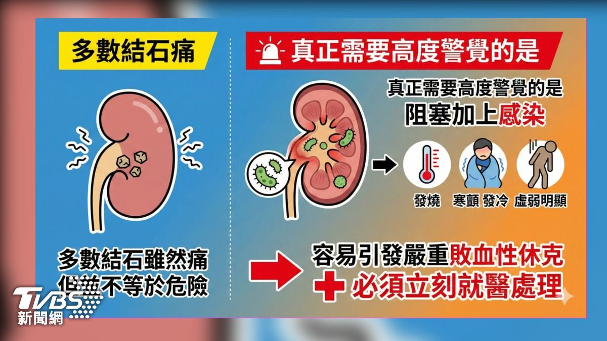 尿道結石恐敗血症 醫師示警:尿不出速就醫! (圖/蔣志偉)
