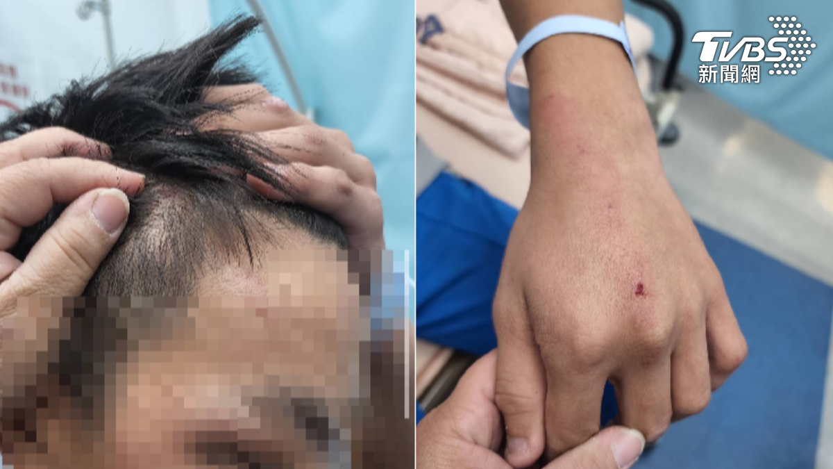 國中生被同學攻擊到多處是傷。（圖／民眾提供）