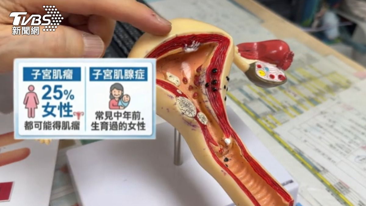子宮肌腺症常見中年前、生育過的女性。（圖／TVBS）