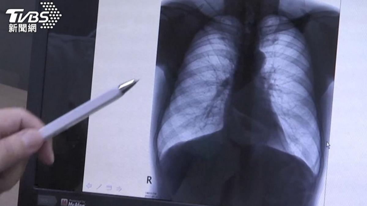 癌症好了卻奪命?6旬男肺癌「忽略1事」 醫曝關鍵原因