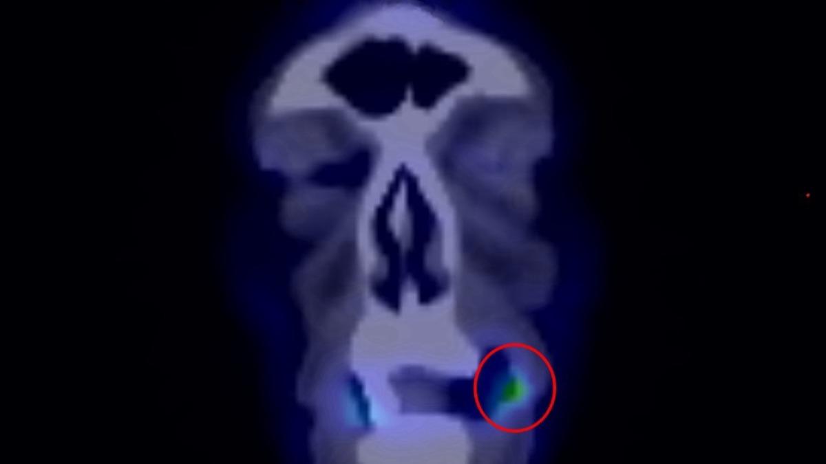 嘴破不痛=沒事?台中男忍3個月腫瘤長到嘴角 一照是口腔癌