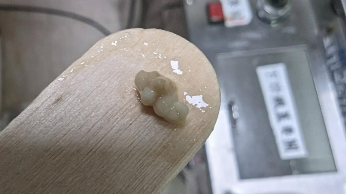 嘴巴吐「米白顆粒」臭爆!一半台人都有 醫揭1習慣養成結石