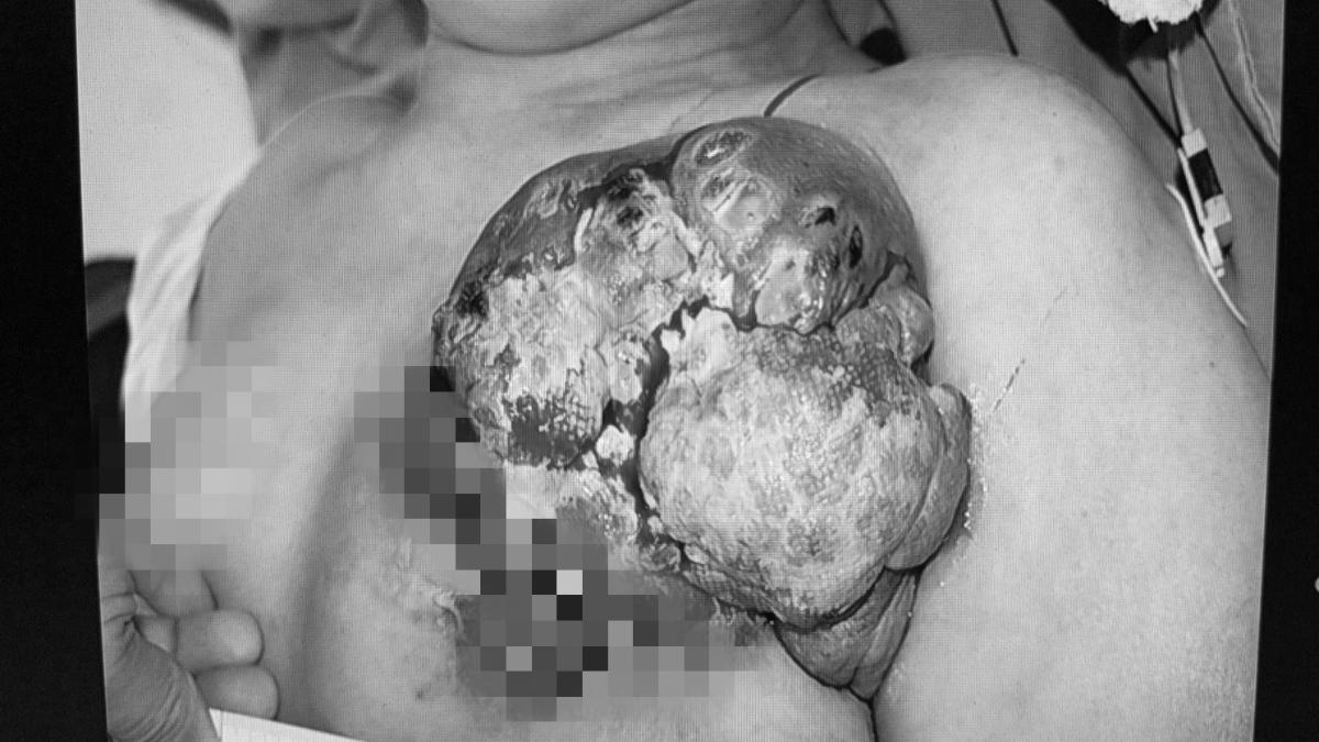 簡單學衛教/乳癌1分鐘1死!8徵兆6族群別拖 20歲就中非罕見