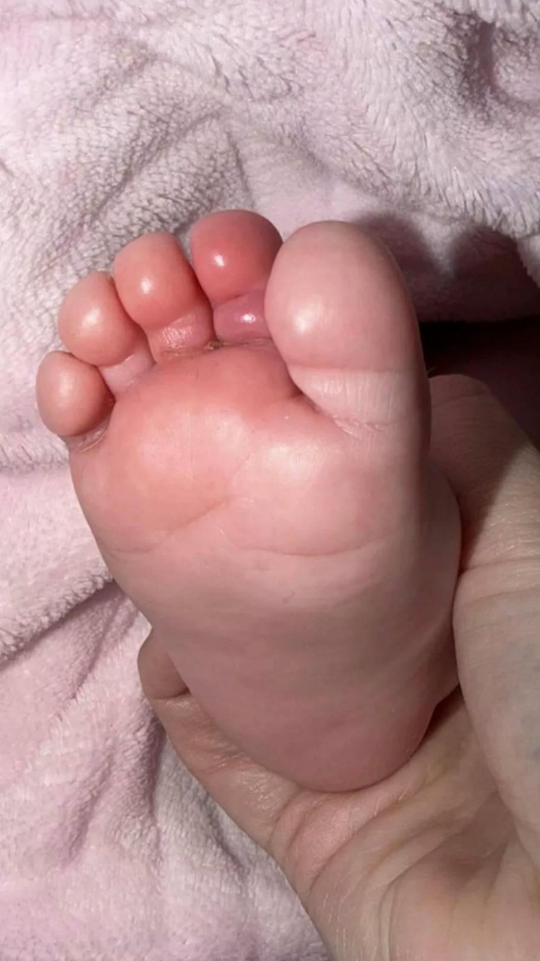頭髮阻斷女嬰腳趾的血液流通,差點就要截肢。(圖/翻攝自網路)