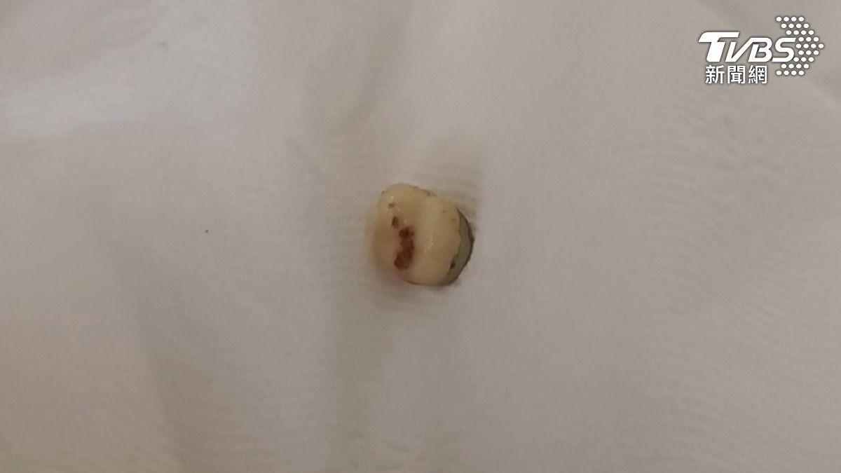 紫米芋頭糕內竟然有一顆假牙，消費者立刻吐出，牙齒吃到嘴巴裡面，吐了2-3次，然後漱口、刷牙，還是感到噁心（圖／TVBS）
