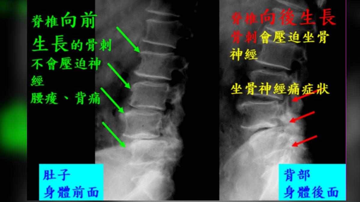 圖/北榮脊椎外科主任、國立陽明大學醫學院教授 周伯鑫醫師