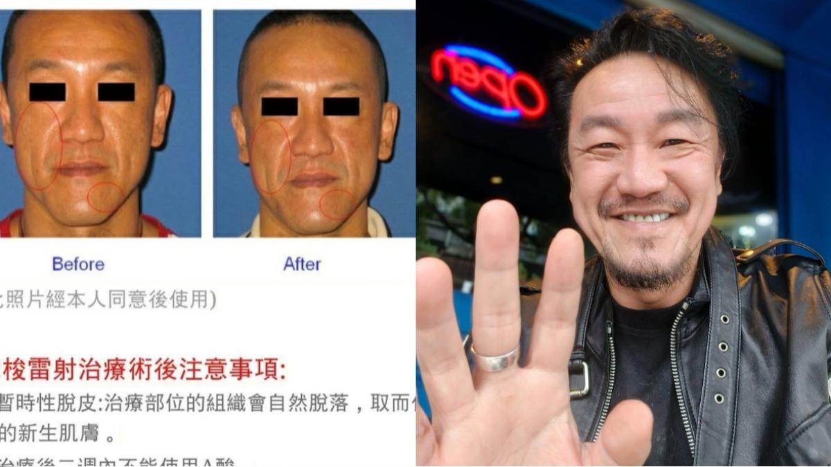 醫美模特打馬仍被認出！網一看秒喊「是陳為民」　釣出本人神回覆