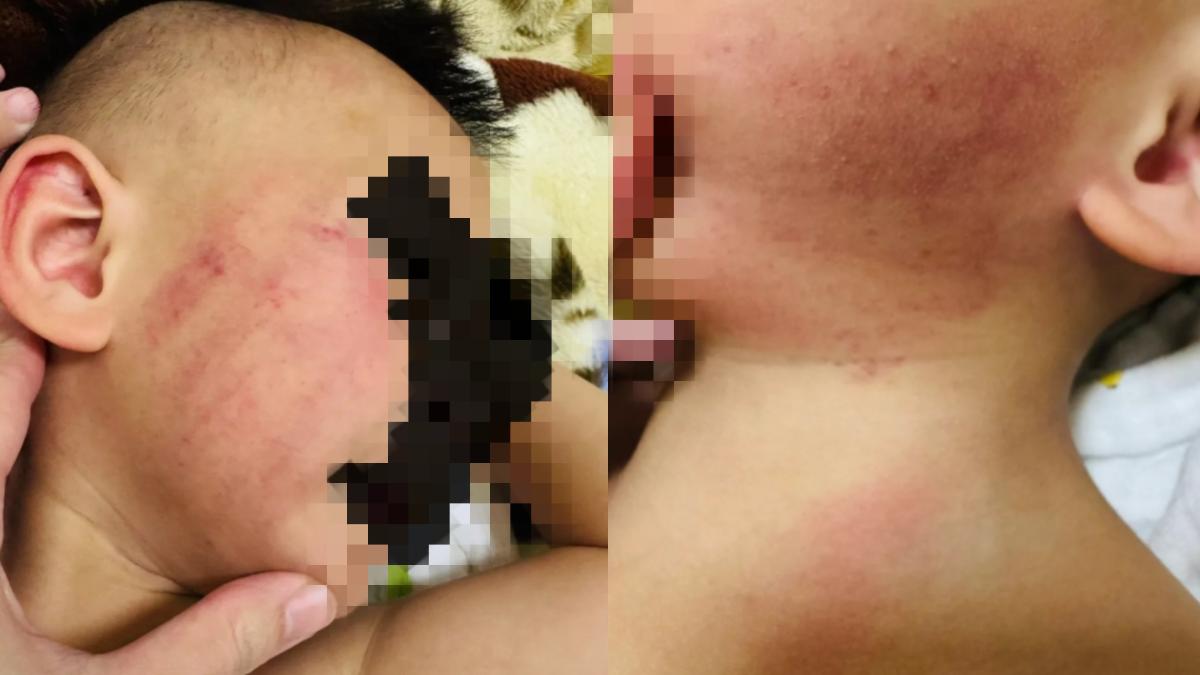 新竹某私幼涉虐!童臉部、耳朵「大片紅腫瘀青」 園方認了致歉