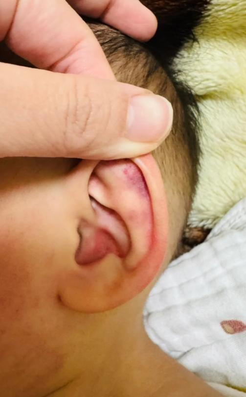 一名幼兒遭教師虐待,臉部、耳朵皆有瘀青。(圖/家屬授權提供)