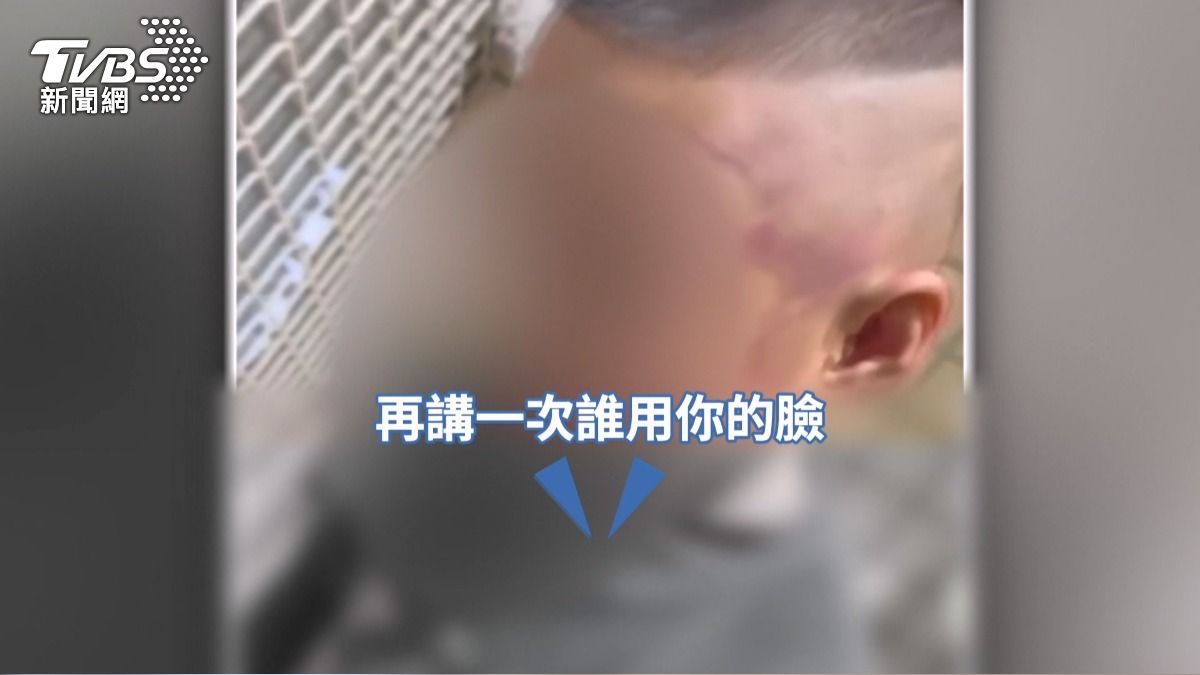 頭腫男童驗傷驚見菸疤!疑遭母男友毆打 母稱「小孩愛說謊」遭親友打臉。(畫面翻攝 Instagram)