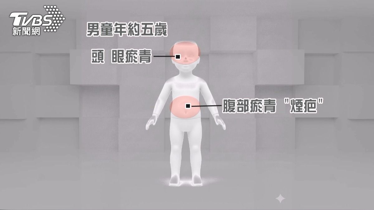 5歲童臉腫如麵包 驗傷驚見「菸疤」。(圖/TVBS)