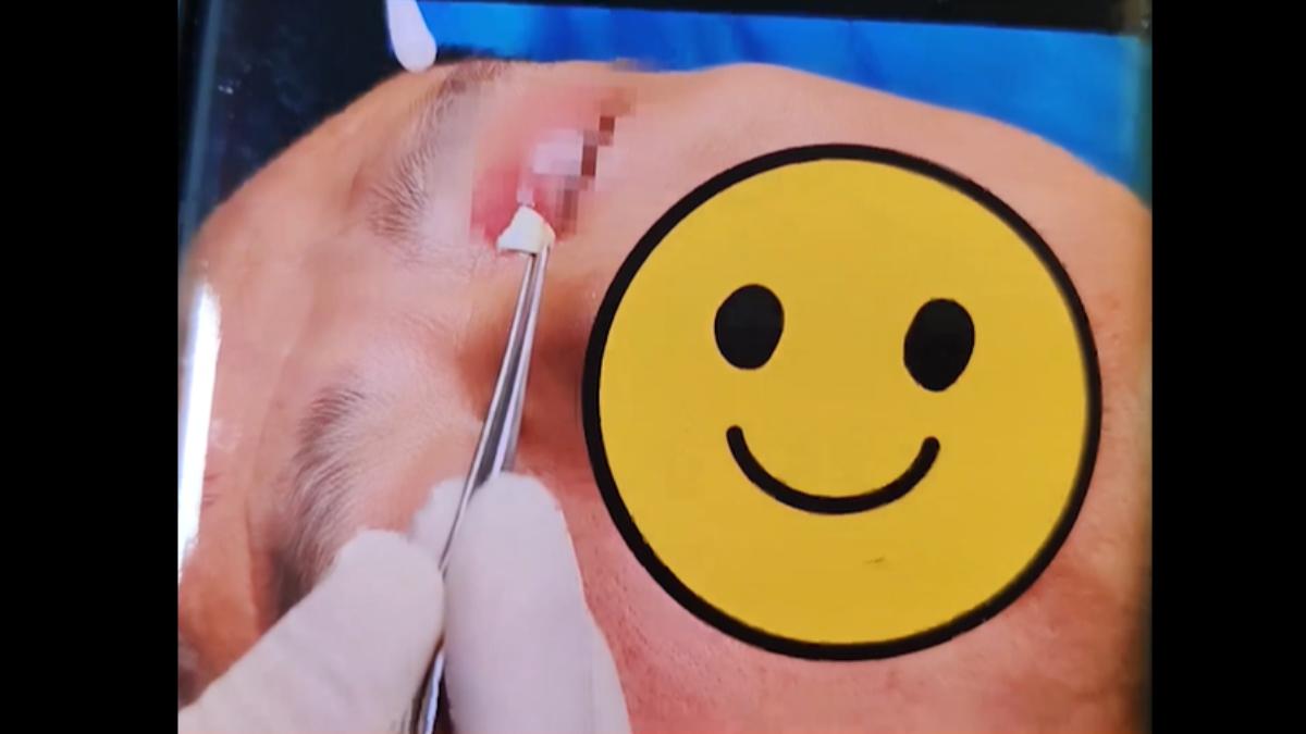 眼睛痛竟拔出筆頭！陸男回想「27年前被戳眼」　醫驚：比眼球長