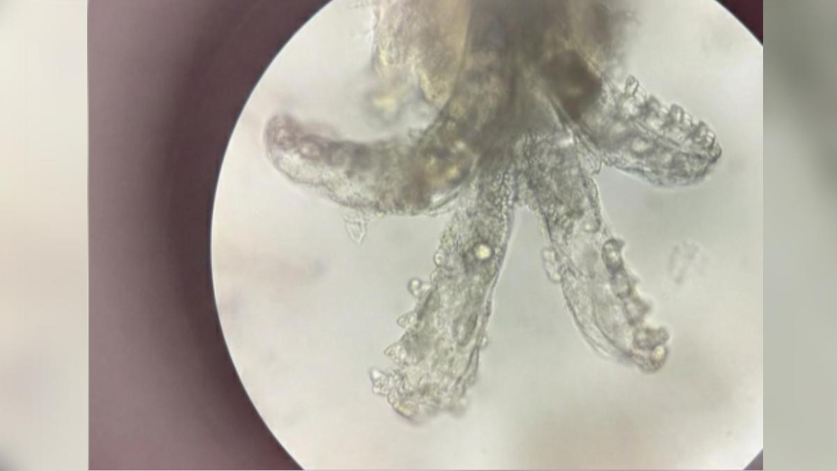爛痘1年治不好!女大生臉藏「百隻8腳蟲」狂繁殖 醫:妳餵飽牠們