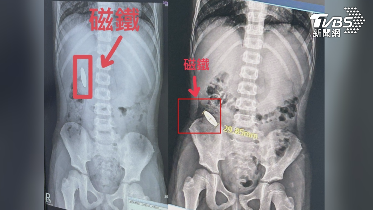 磁鐵還卡在學童腸道裡。（圖／TVBS）