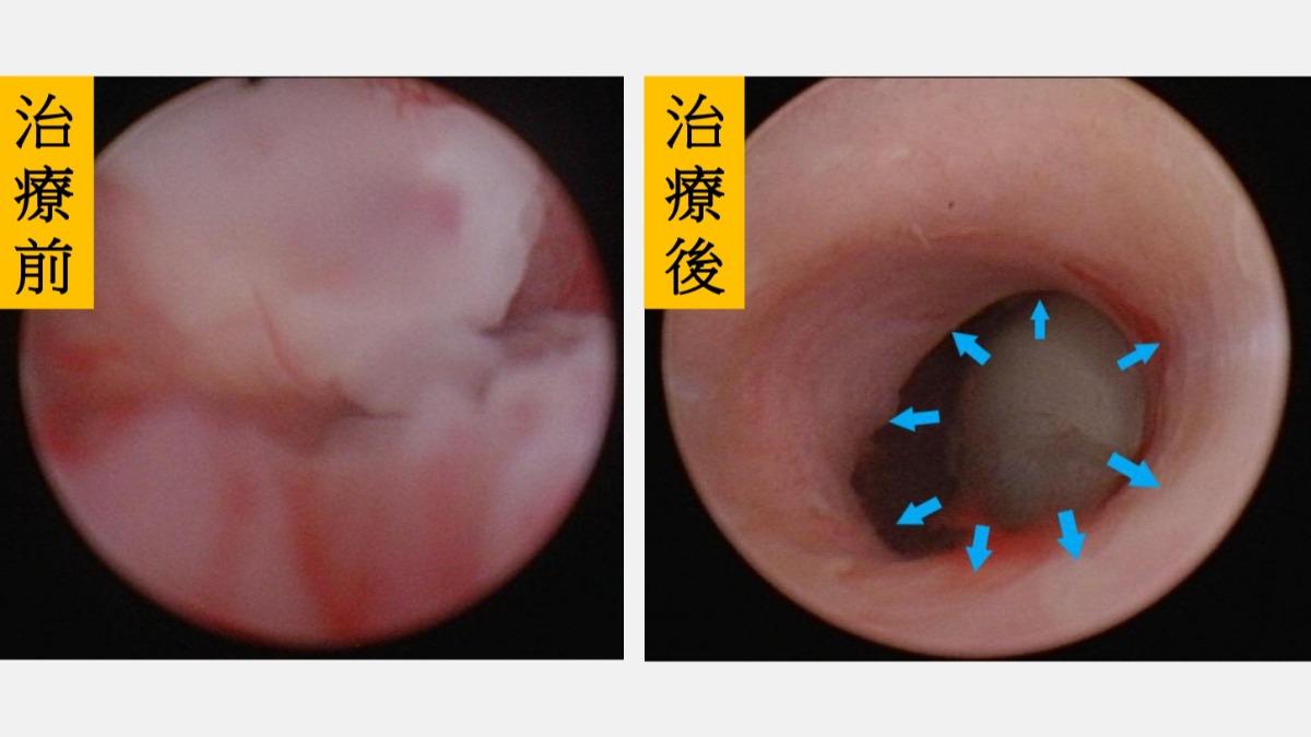 小便痛竟是罕見癌！台中婦尿道塞滿腫瘤　醫嘆：剩53％能活