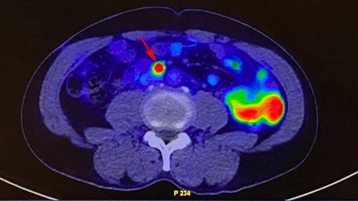 無症狀致死率高！3成攝護腺癌發現已轉移　最新檢測神器問世