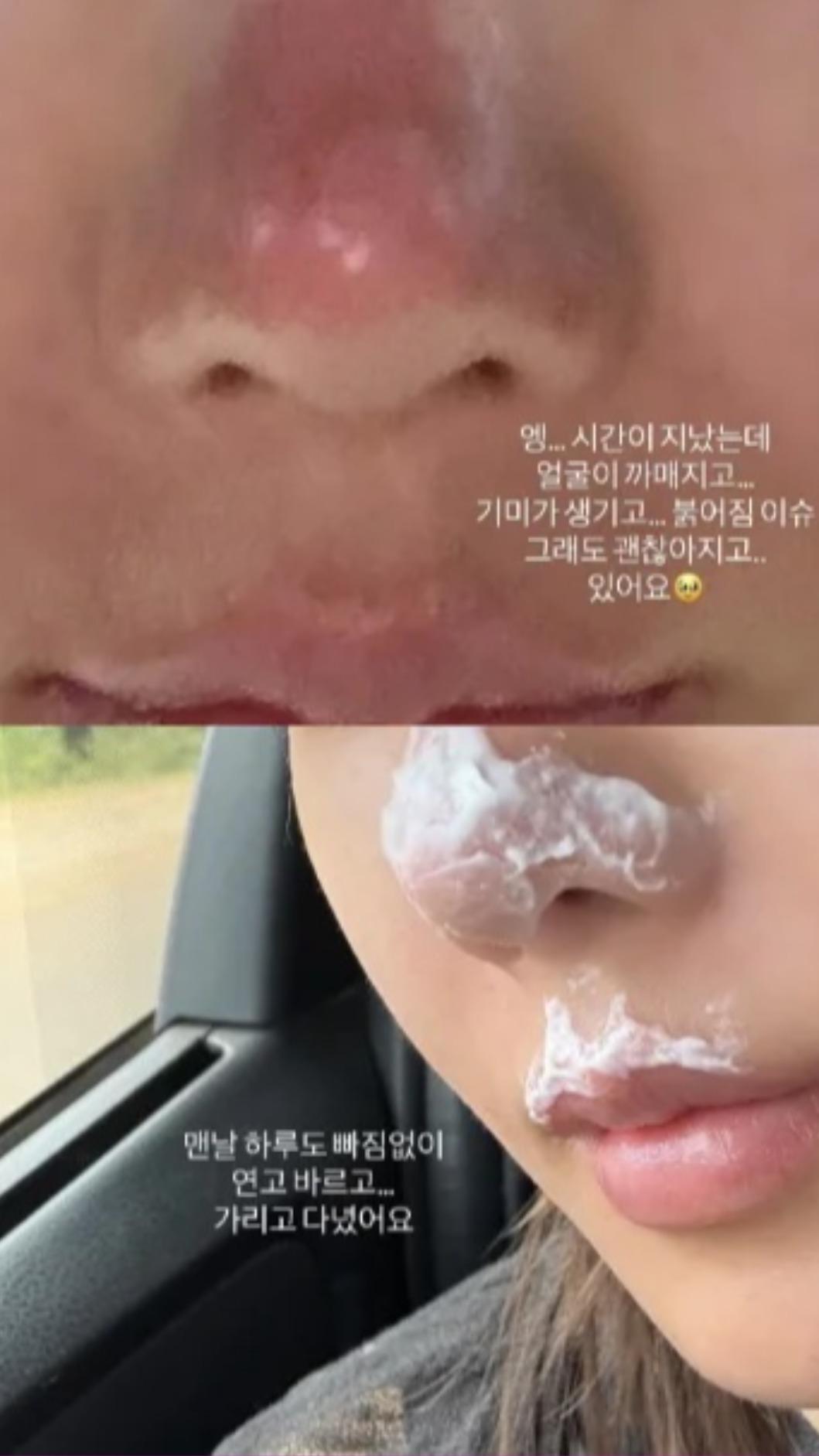 權恩妃在IG分享臉部灼傷的慘況，不過如今已經順利康復。（圖／翻攝自IG）