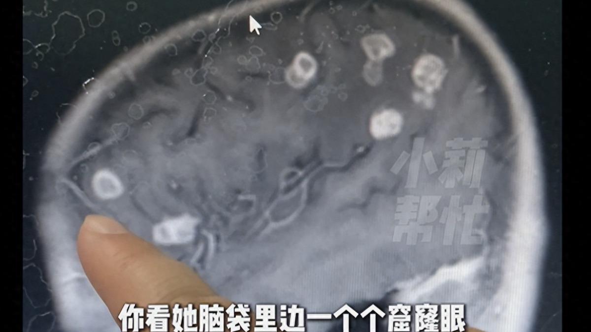 河南一名6歲女童在大掃除後導致腦穿20個洞。(圖/翻攝自紅星新聞)