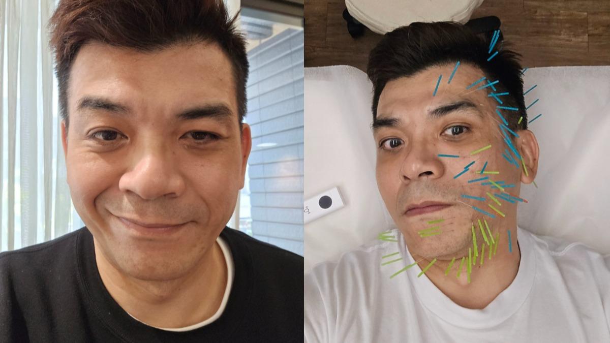 史丹利病毒感染左臉麻痺!醫揭「1現象」恐致角膜潰瘍 好發期曝
