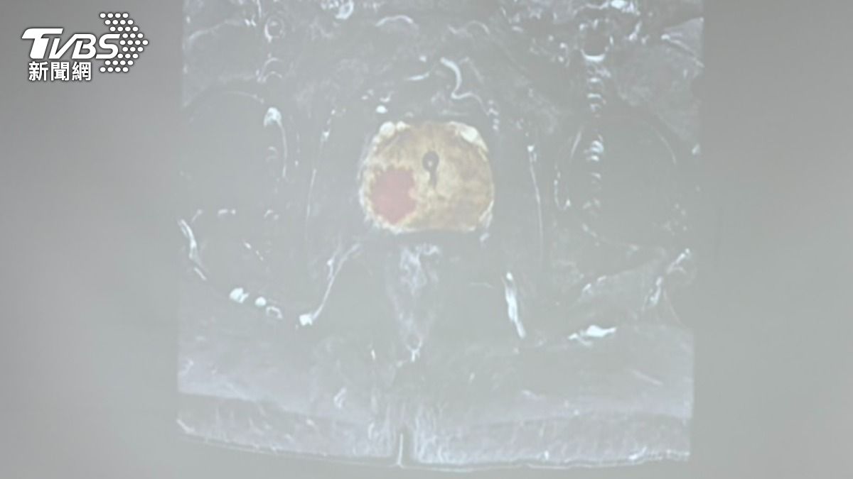 5旬男半數有攝護腺肥大!台中男尿不出來認沒事 已癌二期了