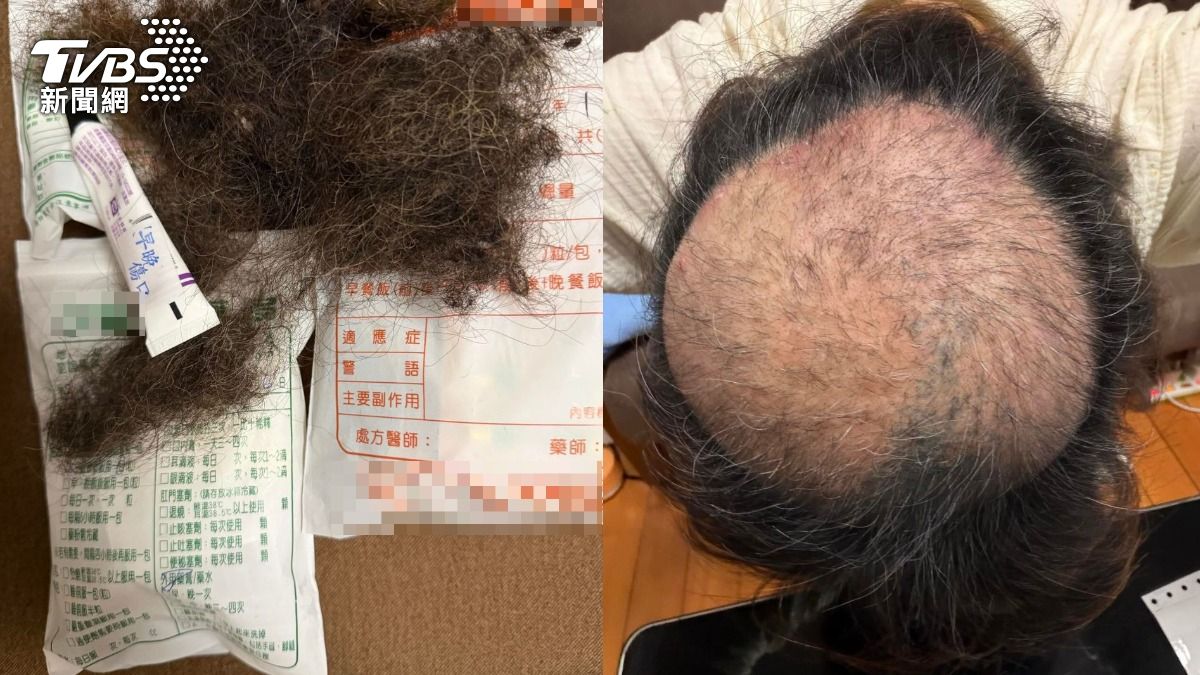 網友長期被異味影響,身心焦慮到拔光頭髮。(圖/當事人提供)