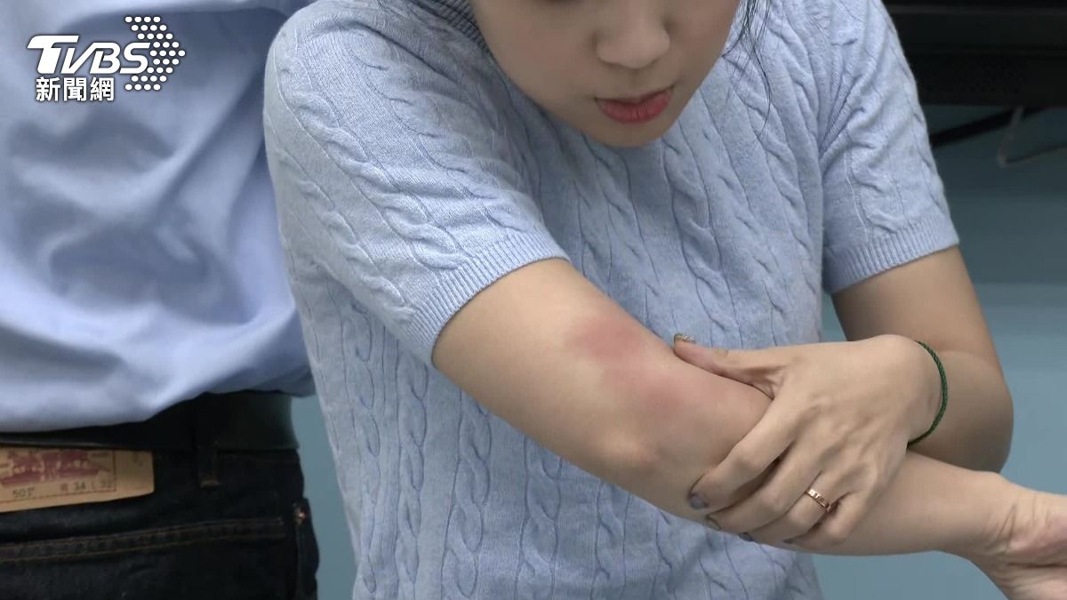 徐巧芯右側手臂受傷紅腫。(圖/TVBS資料畫面)