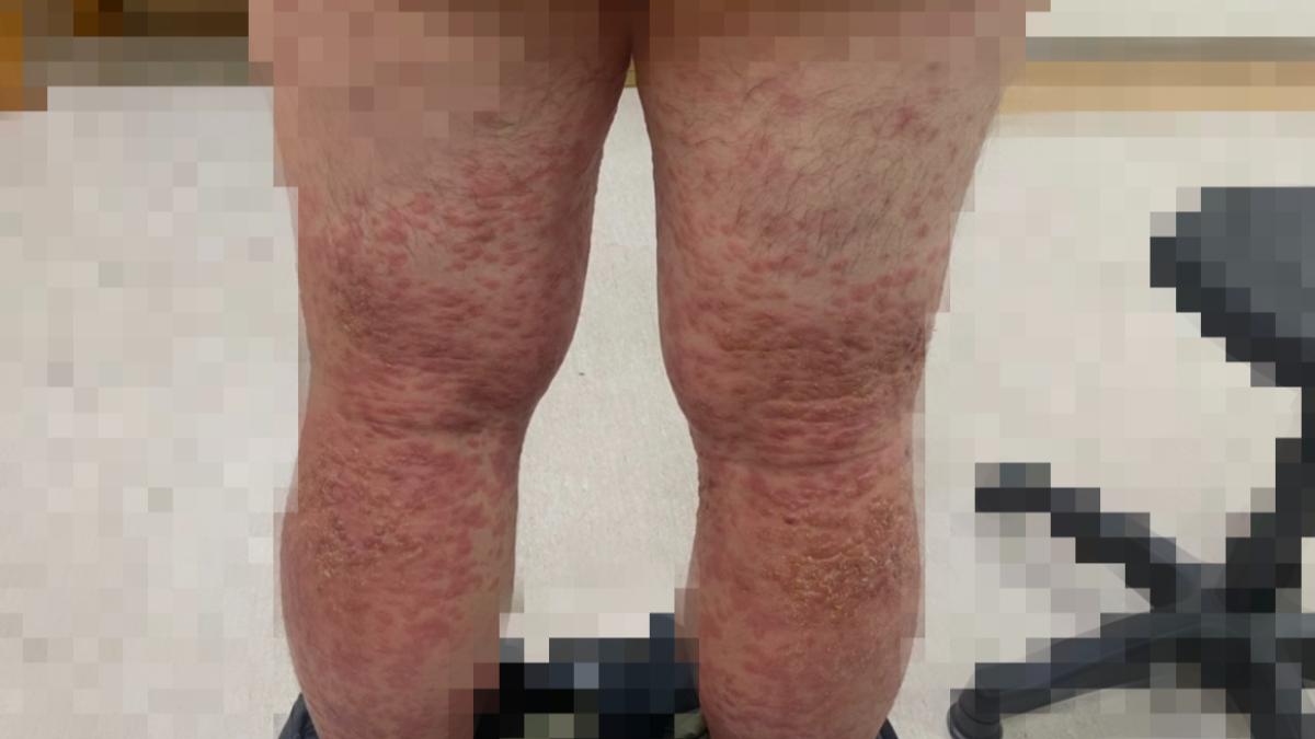 胃痛還長潰瘍腫塊!台中男以為罹癌 醫見檢驗結果驚:梅毒