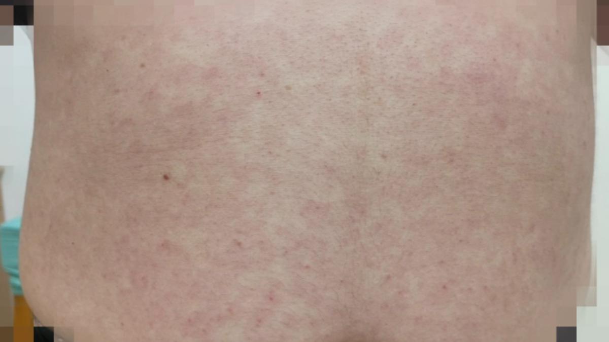 楊清鎮補充目前梅毒主要靠RPR與TPPA兩大檢測。(示意圖,非本案當事人/光田醫院感染科醫師楊清鎮提供)