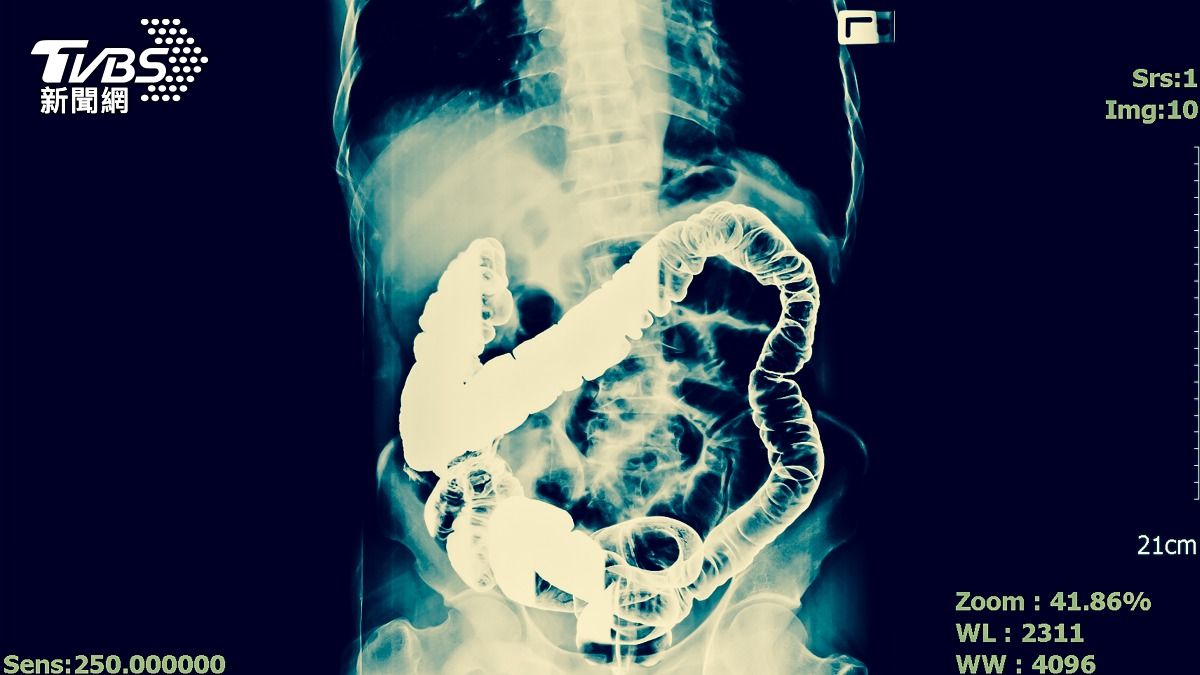 腳麻竟大腸癌末期!5旬婦「沒血便、腹痛」 醫:已轉移脊椎、肝