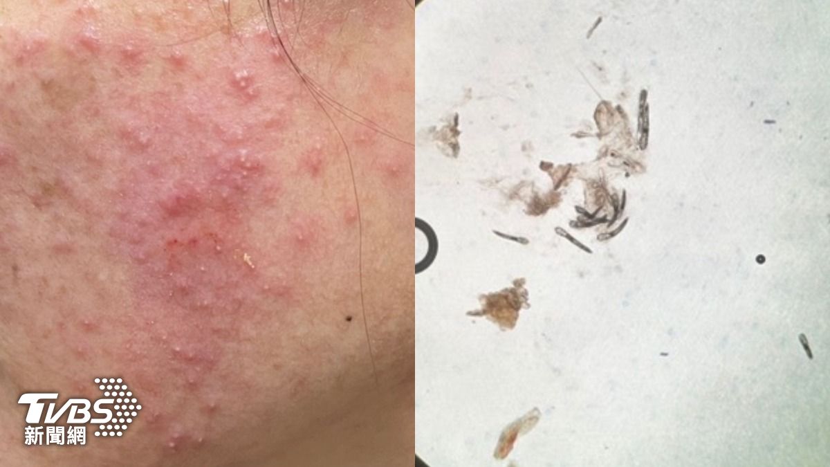 不是痘痘!台中婦左右臉冒腫癢紅疹 每平方公分驚見30隻寄生蟲
