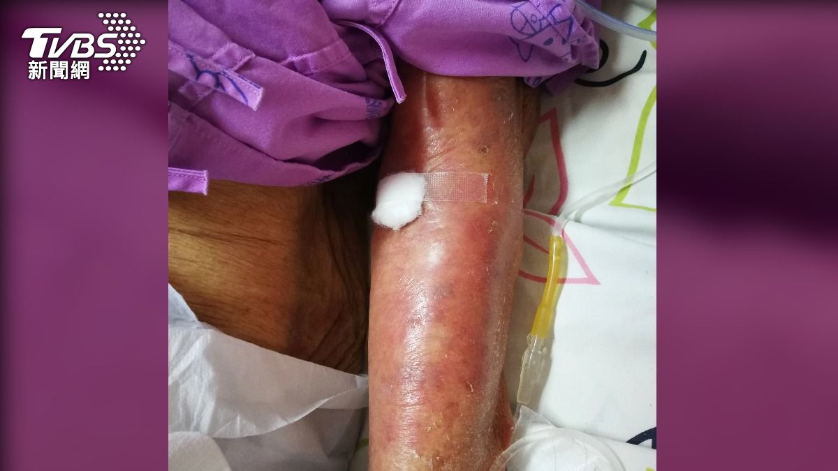 僅16天！30歲洋女吃這藥患上罕病　8成皮膚潰爛、雙眼永久失明