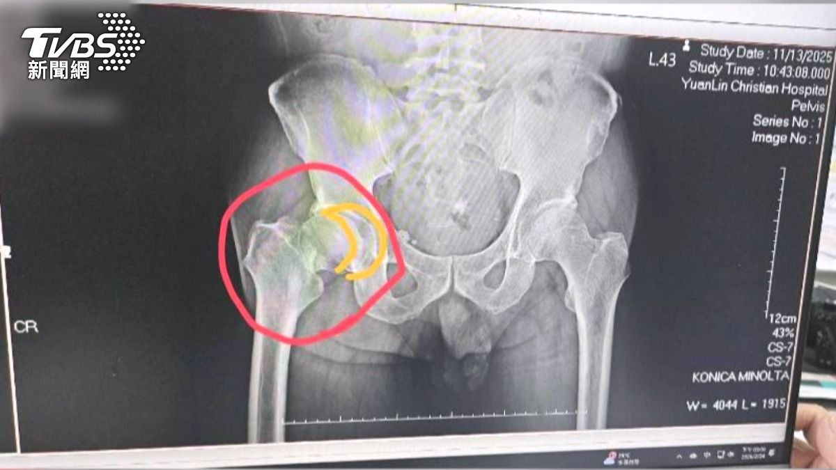 女兒當面撤自費項目！父仍被裝陶瓷關節　家屬怒：監視器都有錄。(圖／TVBS)