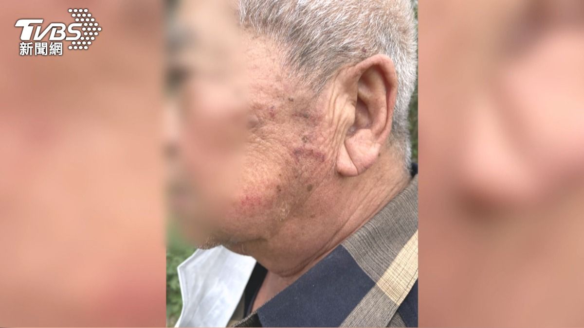 台中騎士攔車動粗!71歲翁遭毆「雙手皮開肉綻、左臉腫脹」家屬心痛。(圖/TVBS)