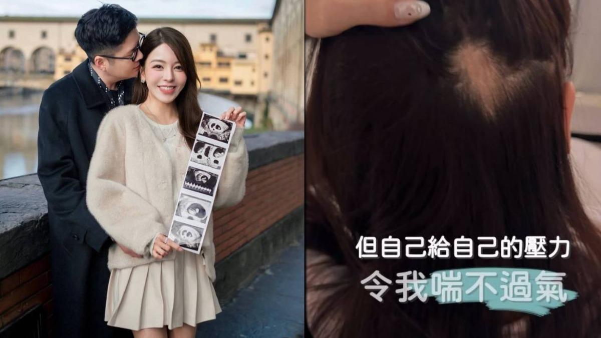 求子太苦!女模試管喜懷雙胞胎 壓力大到「50元大鬼剃頭」