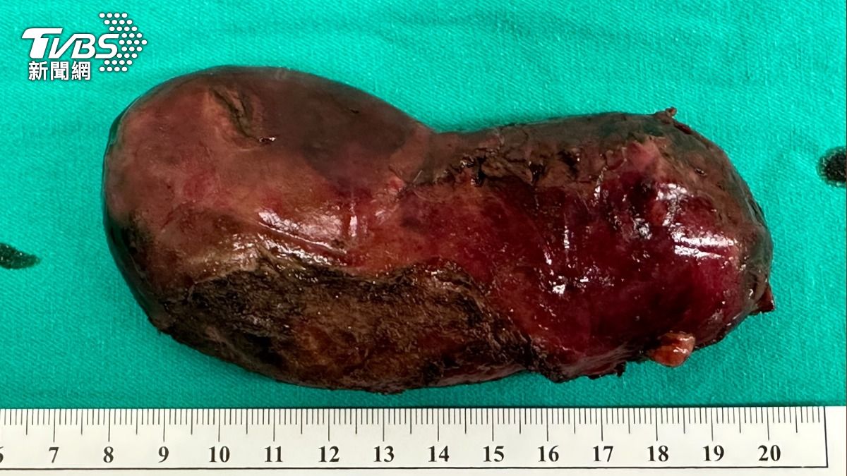 腹痛3天沒好!台中男拖到膽囊發黑壞死 6症狀死亡率22%