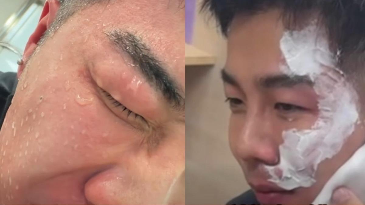 一生叔叔遭毆打，臉部紅腫，並塗上藥膏救治。（圖／翻攝自一生叔叔-Eason臉書）