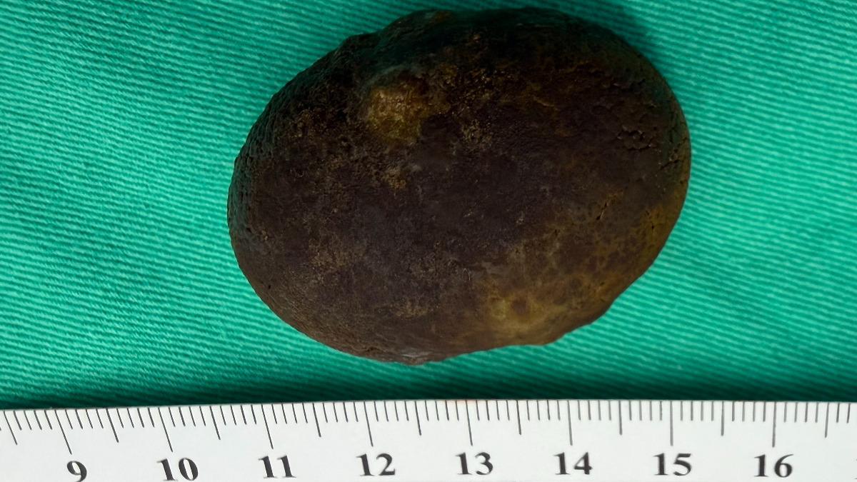 不開刀靠偏方就排膽結石？醫嘆「會害死人」　再拖癌症風險暴增