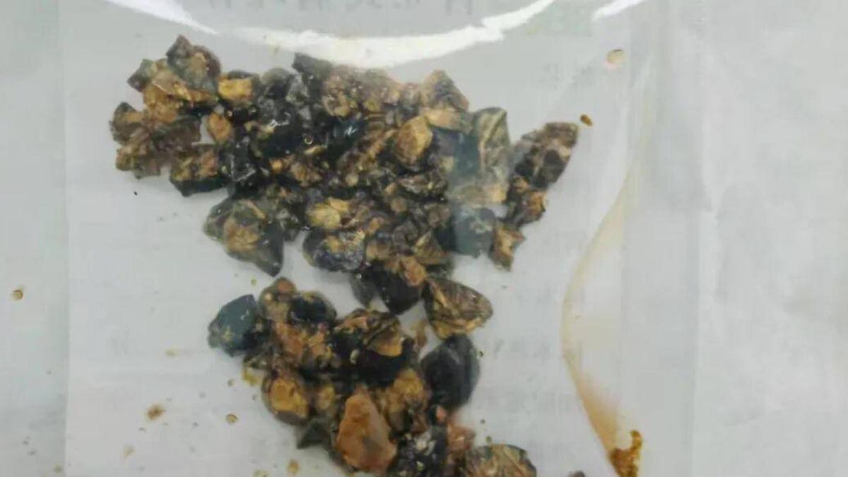 忙工作不吃早餐!陸女腹部劇痛站不直 送醫驚現體內逾60顆結石