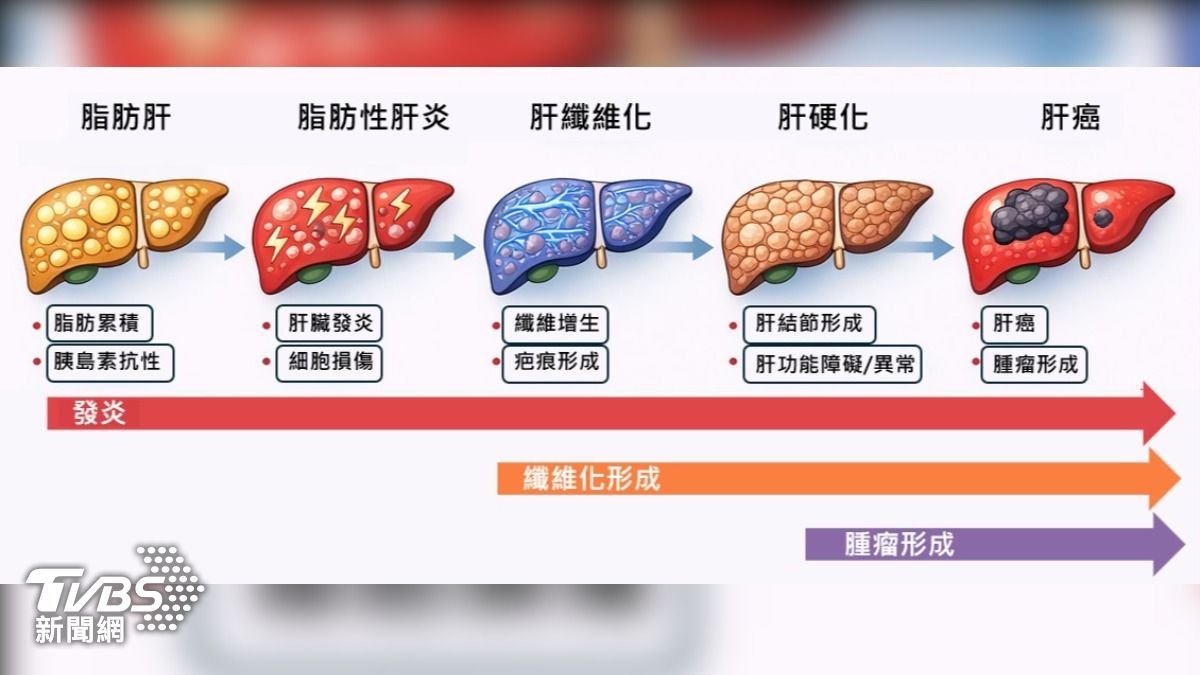 脂肪肝進入新時代:從「代謝失衡」到「肝纖維化」醫療策略全面翻轉 (圖/TVBS)