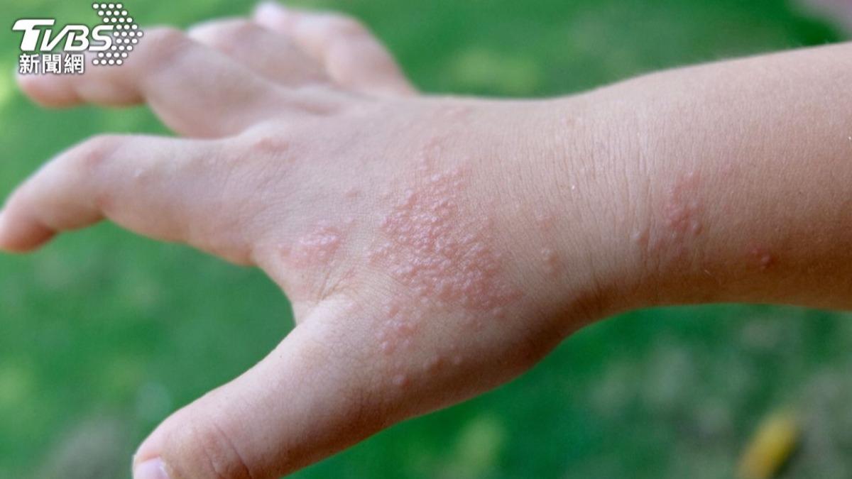 換季手腳狂長「汗皰疹」癢爆!醫曝7原因 1茶飲除身體濕氣