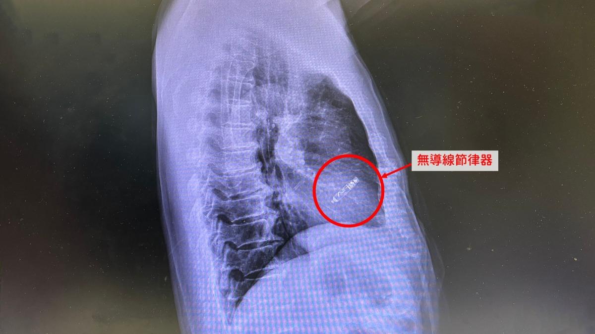 一名婦人反覆昏倒，心跳一天停超過五千次。（圖／中國醫藥大學新竹附設醫院提供）