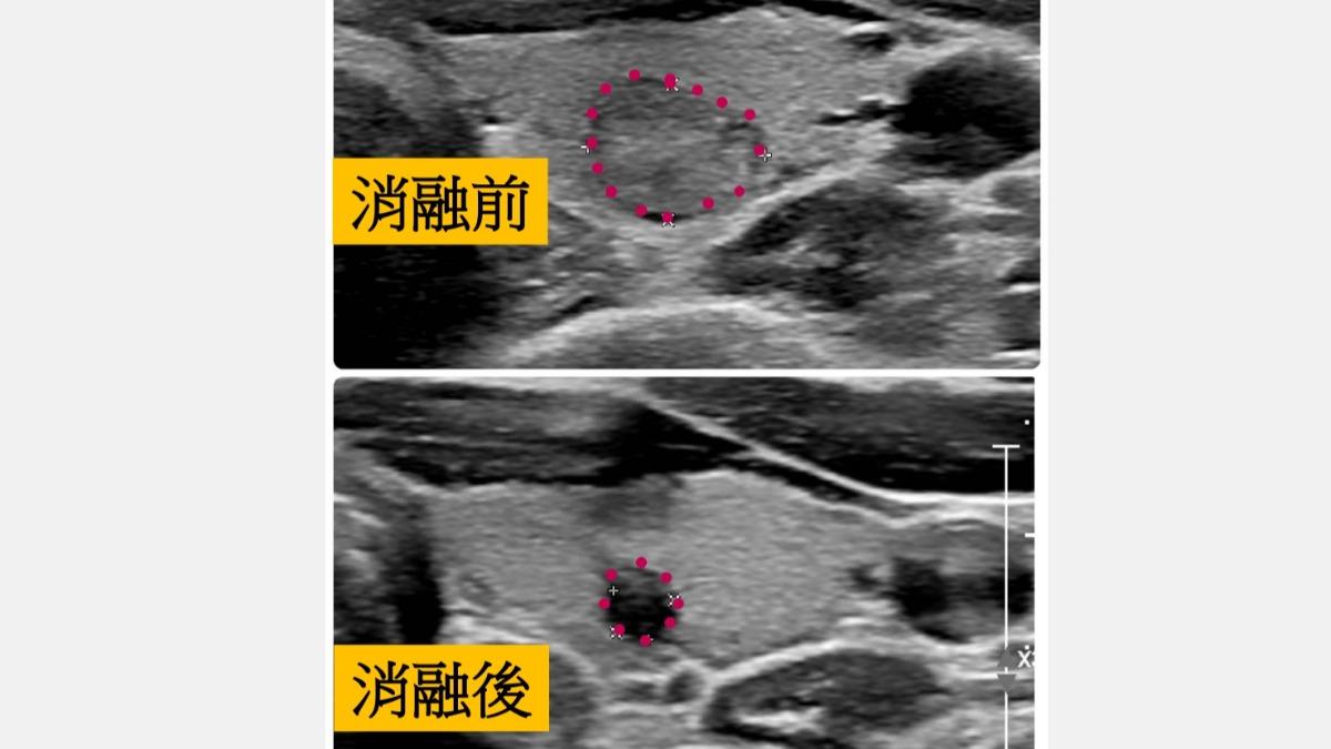 甲狀腺癌四期存活率25%!台中女30歲就中 1症狀4類人小心