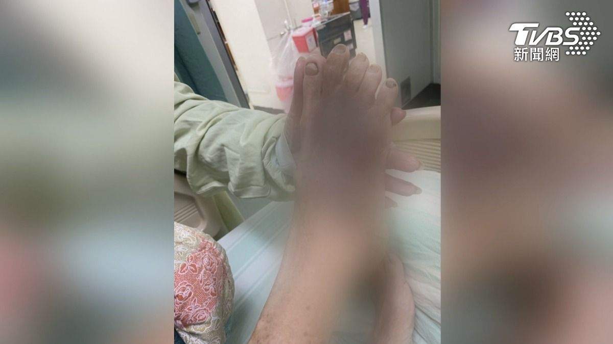 高齡90歲的阿嬤躺在病床上，手腳、臉部和頭部有大片瘀青，甚至腦出血住進加護病房（圖／TVBS）